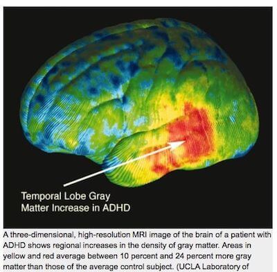 3d hi res MRI image of the brain of a patient with ADHD shows regional increases in the density of gray matter.