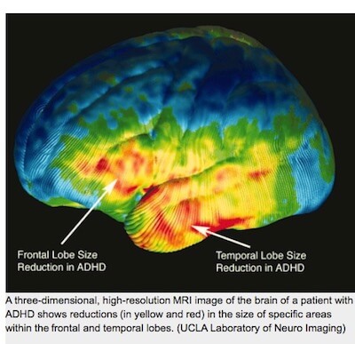 A three-dimensional, high-resolution MRI image of the brain of a patient with ADHD shows reductions (in yellow and red) in the size of specific areas within the frontal and temporal lobes.