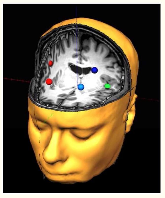 Dorsolateral prefrontal and auditory regions of interest