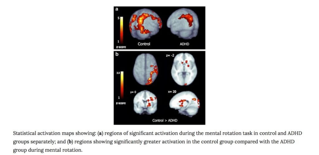Right parietal dysfunction in children with attention deficit hyperactivity disorder, combined type- a functional MRI study